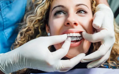 SureSmile Clear Aligners: A Comprehensive Review for Charlotte Patients