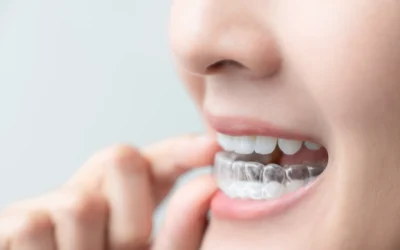 Why Summer Is the Best Time to Start Clear Aligners in Charlotte