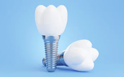 Dental Implants: Are They Truly a Permanent Solution for Tooth Loss?